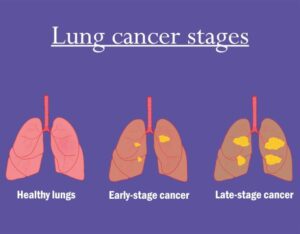 What Causes Lung Cancer Metastasis And Where Does It Spread