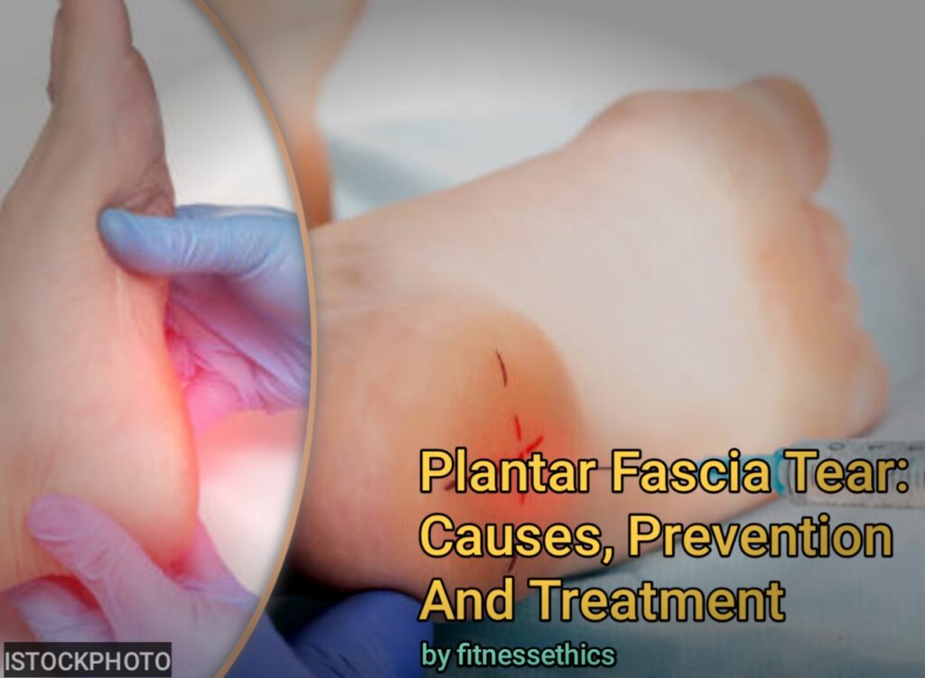 Plantar Fascia Tear: Causes, Prevention And Treatment