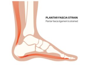 Plantar Fascia Tear: Causes, Prevention And Treatment