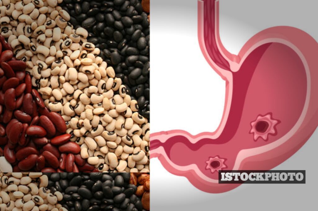 Are Beans Good For Ulcer Patients?