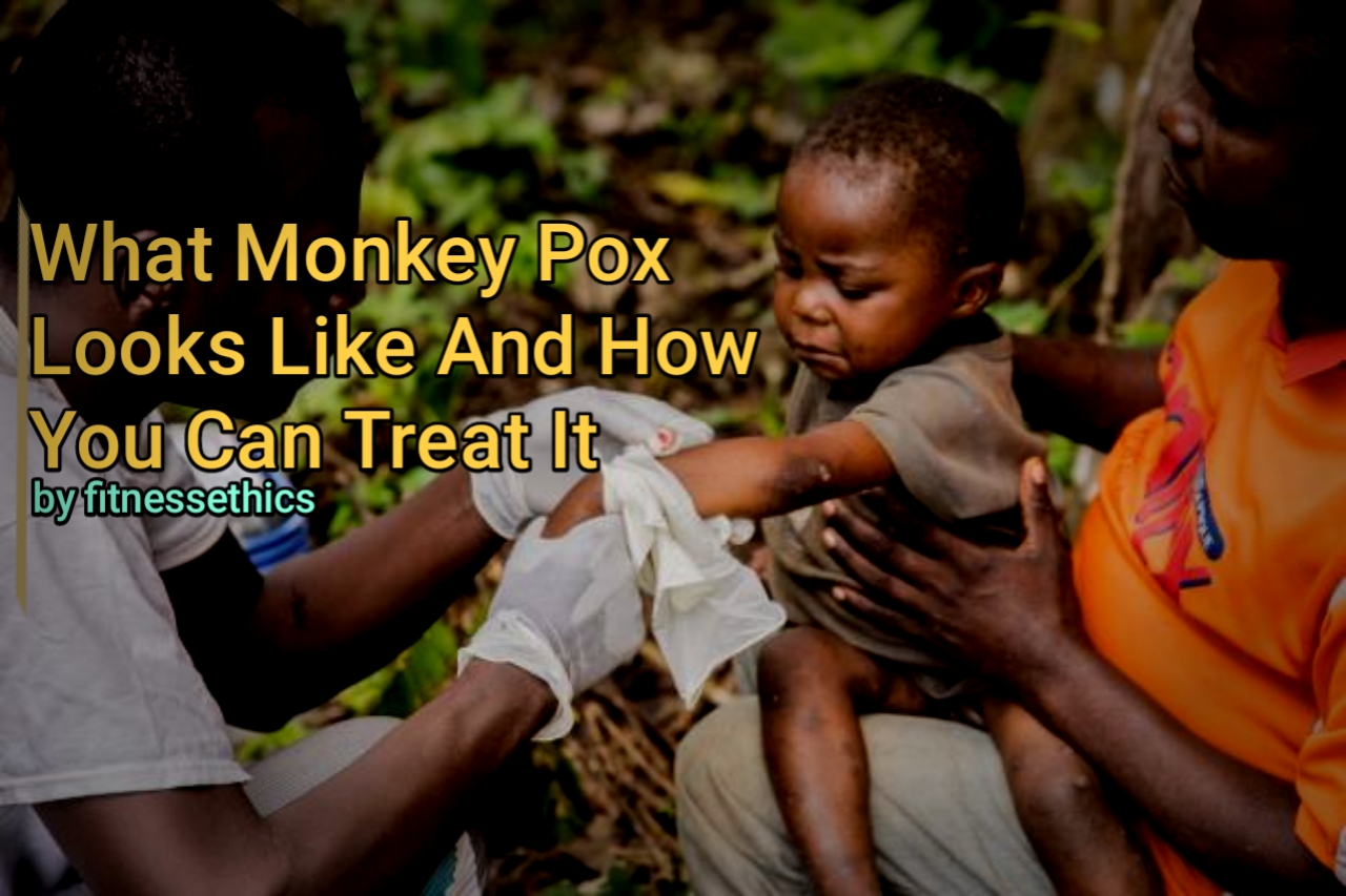 What Monkeypox Looks Like And How You Can Treat It - Fitnessethics Blog