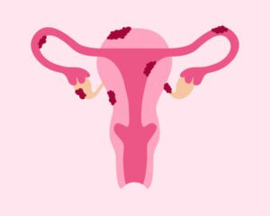 Endometriosis Symptoms And Prevention